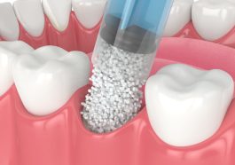 Illustration of dental treatment procedure focusing on teeth and gums