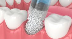 Illustration of dental treatment procedure focusing on teeth and gums