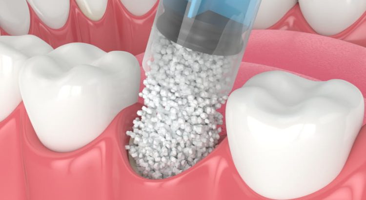 Illustration of dental treatment procedure focusing on teeth and gums