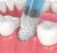 Illustration of dental treatment procedure focusing on teeth and gums
