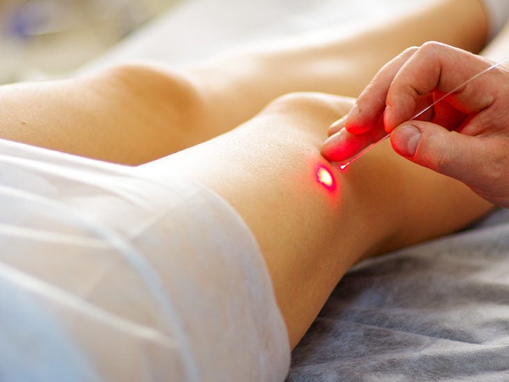 Does Laser Treatment for Varicose Veins Work?