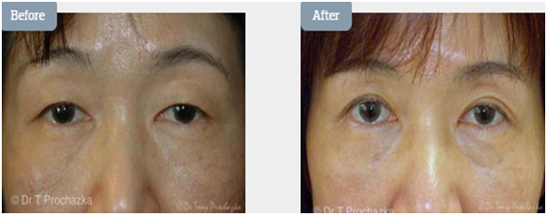 Enhance Your Beauty With An Eyelid Surgery