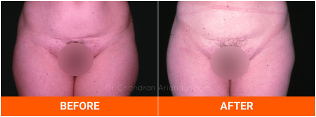 Fix Your Imperfections With These Surgical Procedures